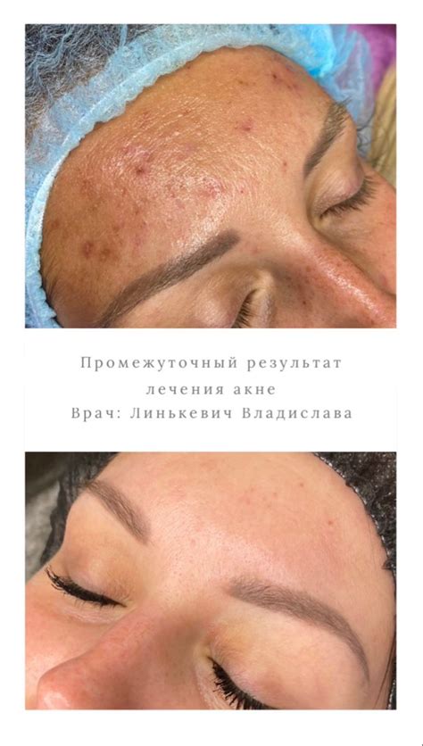 Воздействие увлажняющего средства на проблему акне