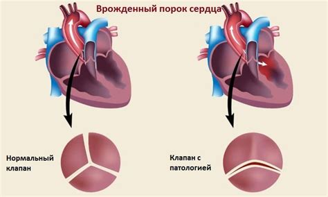 Описание порока сердца