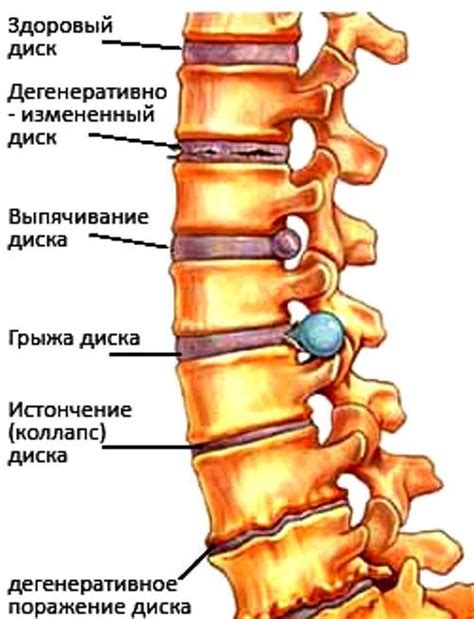 Остеохондроз позвоночника