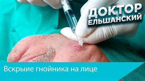 Осторожное открытие гнойника: правильная техника