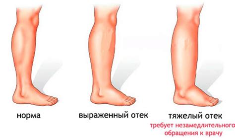 Отеки и набухание ног