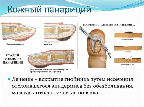 Причины и проявления гнойной инфекции в палец