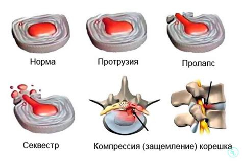 Профилактика грыжи позвоночника: роль душа шарко