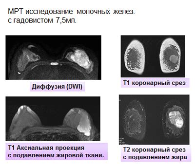 Редкий, но возможный диагноз при обнаружении аномальной массы в молочной железе мужчин