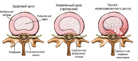 Специальный метод самостоятельного лечения грыжи позвоночника