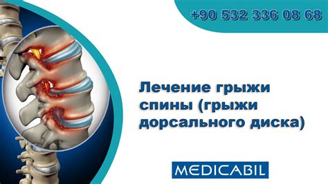 Эффективный способ лечения грыжи спины с помощью душа "шарко"