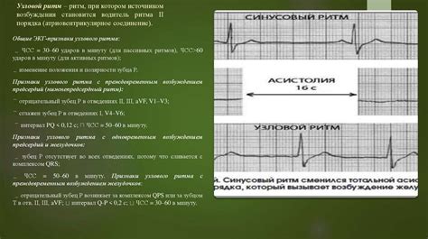  Диагностика и классификация синусовой брадикардии
