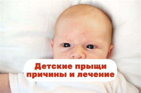 Варианты безопасного удаления прыщей у детей