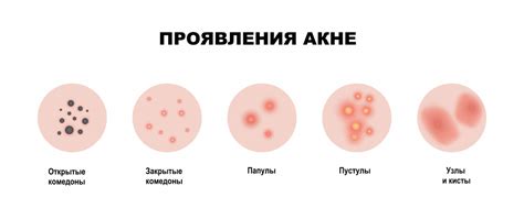 Виды акне в зависимости от места появления