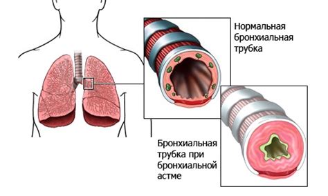 Влияние гретых ног на приступы астмы