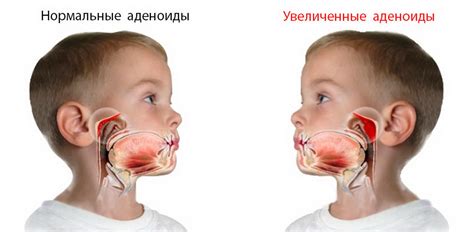 Выгоды купирования аденоидов у детей