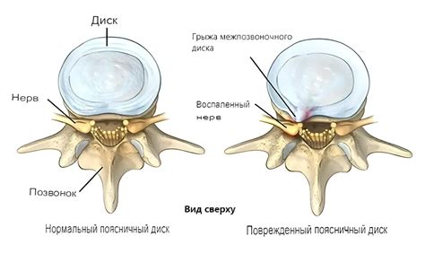 Диагноз межпозвоночной грыжи