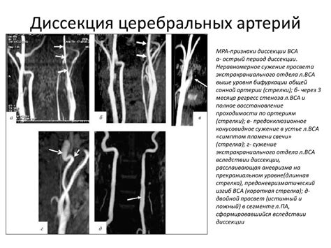 Ишемия в молодом возрасте