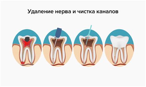 Каким образом врач проводит удаление нерва