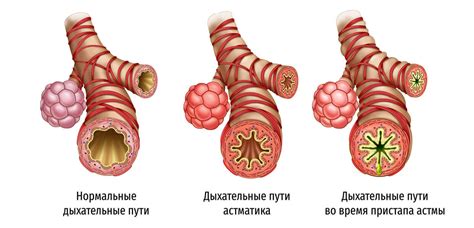 Как носки влияют на состояние бронхиальной астмы
