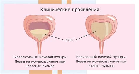 Как узнать, что у ребенка лопнул мочевой пузырь