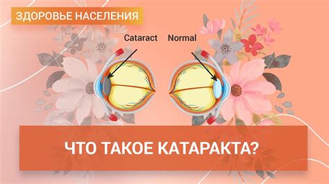 Катаракта: диагностика и лечение