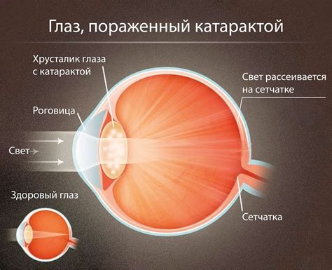 Катаракта: основные методы лечения