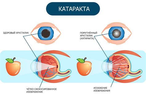 Катаракта: симптомы и причины