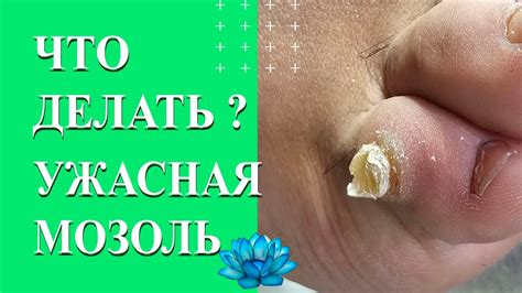 Криотерапия для удаления стержневой мозоли