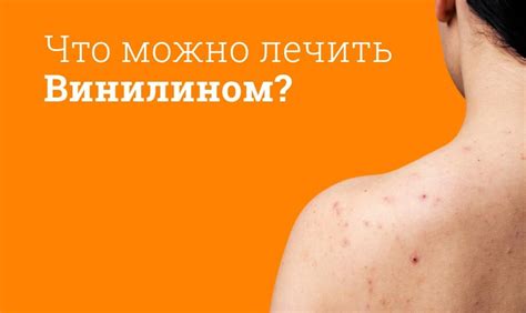 Мазь горло винилином: преимущества и осторожность
