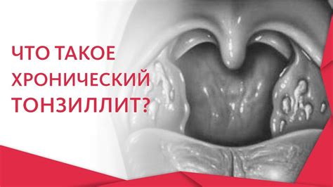 Методы передачи хронического тонзиллита