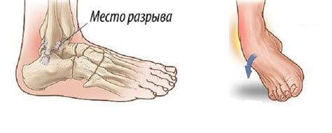Мифы о разрыве связок ноги