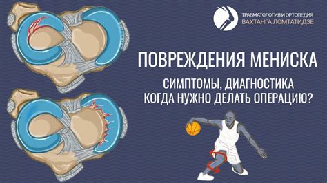 Мысли о операции на мениск
