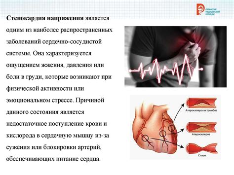 Ограничения и противопоказания к посещению бани при стенокардии напряжения