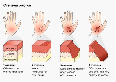 Ожог от утюга на теле: симптомы и признаки