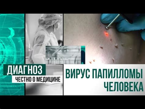 Опасность самостоятельного удаления папиллом при сахарном диабете