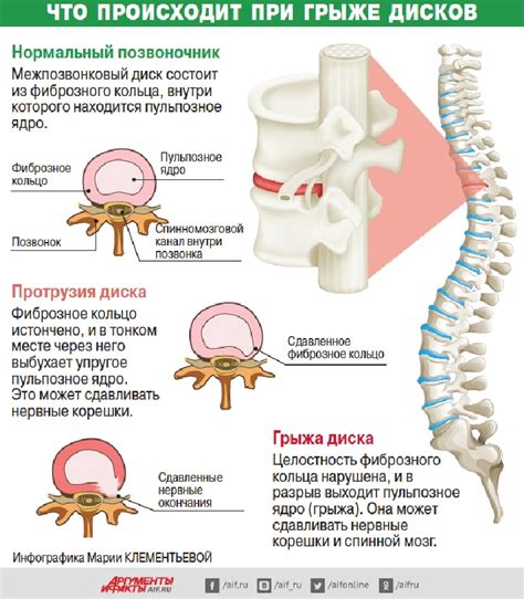 Описание и симптомы грыжи позвоночника