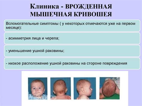 Определение и причины кривошее у новорожденных