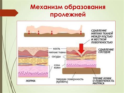 Определение и причины пролежней