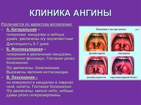 Осложнения при тонзиллите
