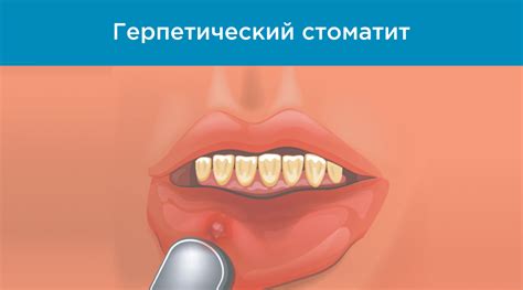 Основные правила целования при стоматите на языке: