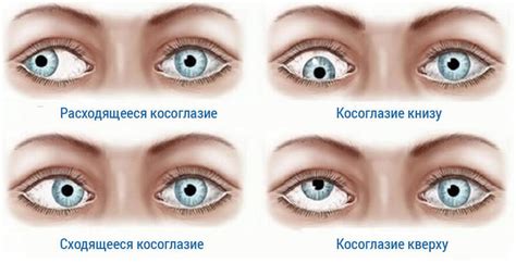 Основные причины двоения в глазах при катаракте