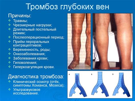 Основные симптомы повышения температуры при воспалении вен