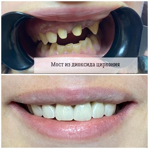 Открытие светящегося циркония