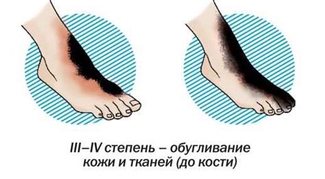 Последствия ожога от утюга и их лечение