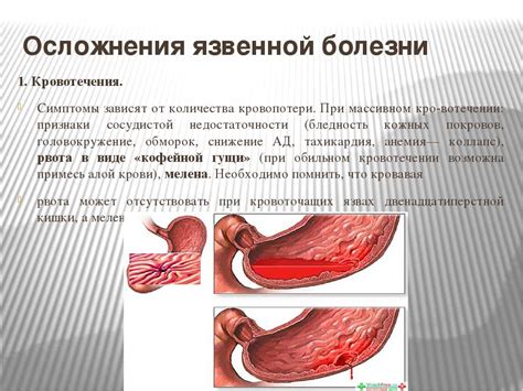 Последствия приема красного вина при язве желудка