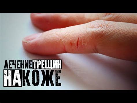 Предотвращение появления трещин и заломов на коже