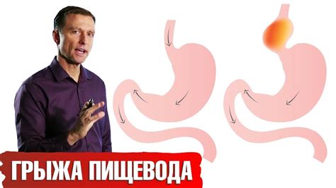 Преимущества массажа при грыже пищевода: восстановление нормальной работы