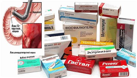 Применение льняного масла в комплексной терапии язвы желудка и двенадцатиперстной кишки