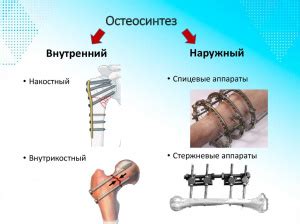 Применение эластичного гипса при лечении переломов