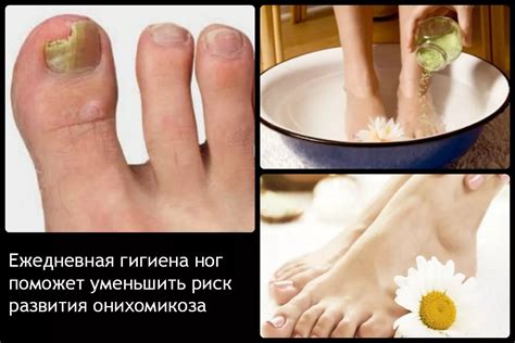 Проблемы связанные с грибком стопы