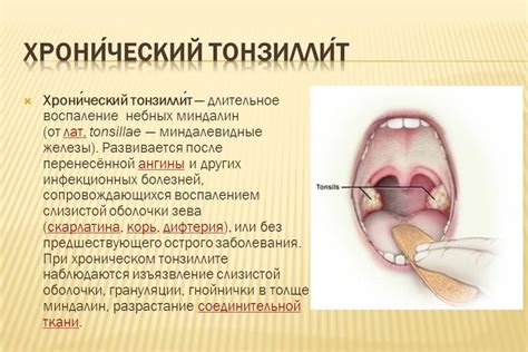 Профиалктика хронического тонзиллита