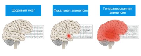 Работа в условиях эпилепсии: особенности и рекомендации