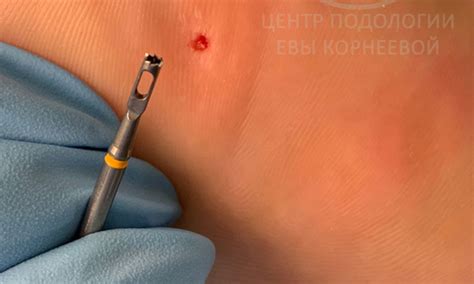 Радиоволновая методика удаления стержневой мозоли