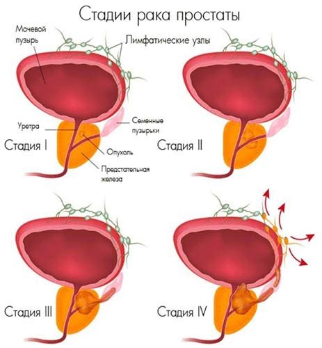 Рак простаты: основные характеристики